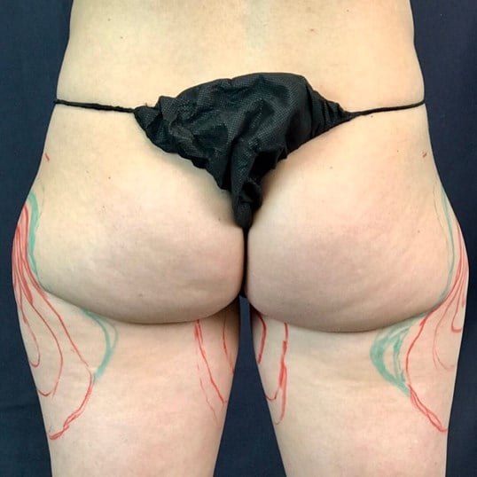 Power Assisted Liposuction Before & After Image