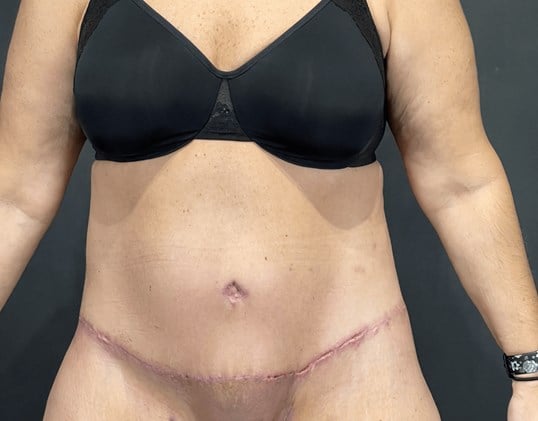 Power Assisted Liposuction Before & After Image