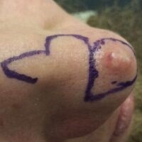 Skin Cancer Removal Before & After Image