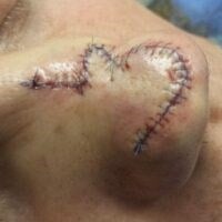 Skin Cancer Removal Before & After Image