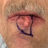 Skin Cancer Removal Before & After Image