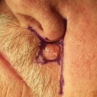 Skin Cancer Removal Before & After Image