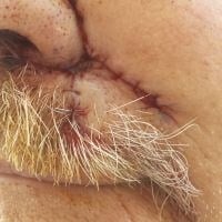 Skin Cancer Removal Before & After Image