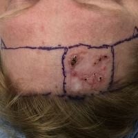 Skin Cancer Removal Before & After Image