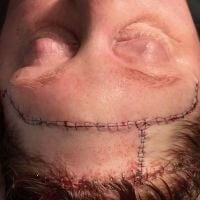 Skin Cancer Removal Before & After Image