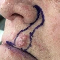 Skin Cancer Removal Before & After Image