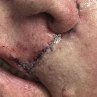Skin Cancer Removal Before & After Image