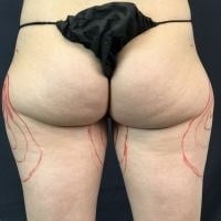 Smartlipo Triplex Before & After Image