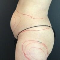 Smartlipo Triplex Before & After Image