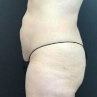 Smartlipo Triplex Before & After Image