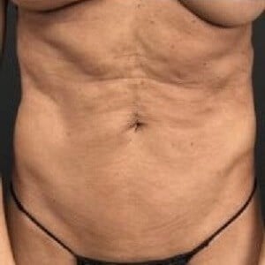 Tummy Tuck Before & After Image