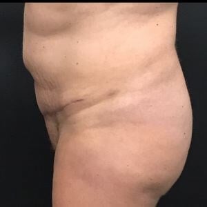 Tummy Tuck Before & After Image