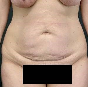 Tummy Tuck Before & After Image
