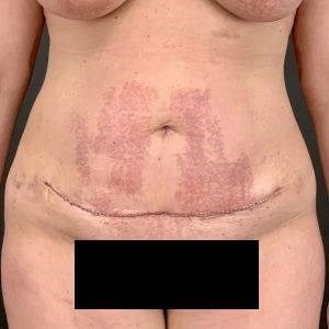 Tummy Tuck Before & After Image