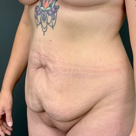 Tummy Tuck Before & After Image