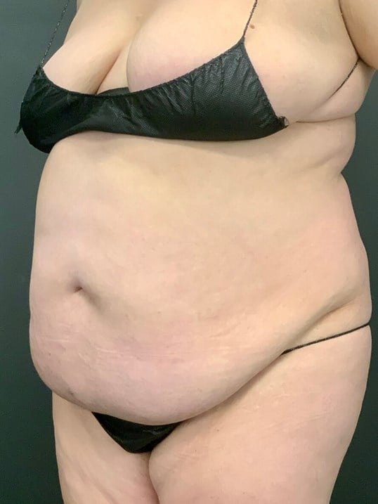 Tummy Tuck Before & After Image