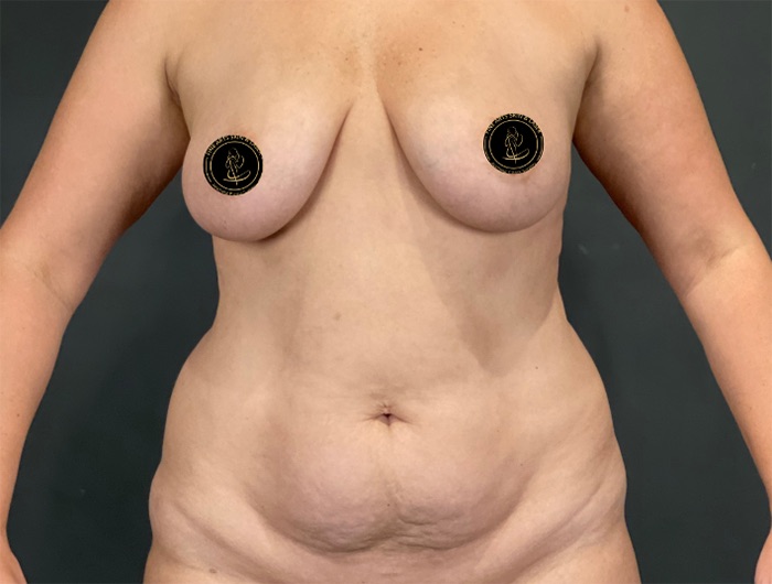 Tummy Tuck Before & After Image