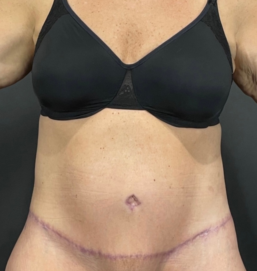 Tummy Tuck Before & After Image