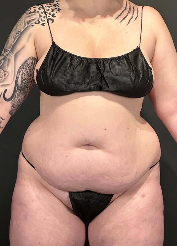 Tummy Tuck Before & After Image