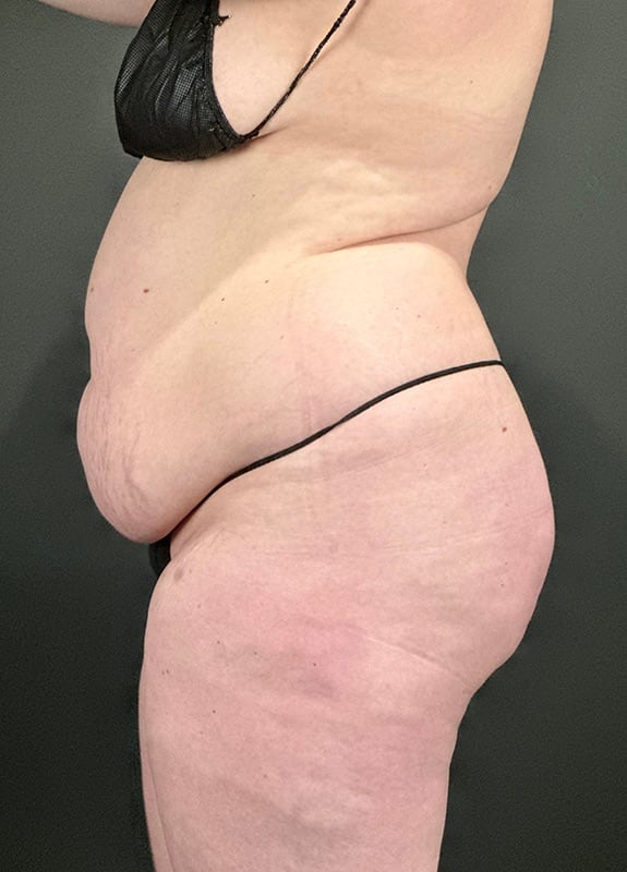 Tummy Tuck Before & After Image