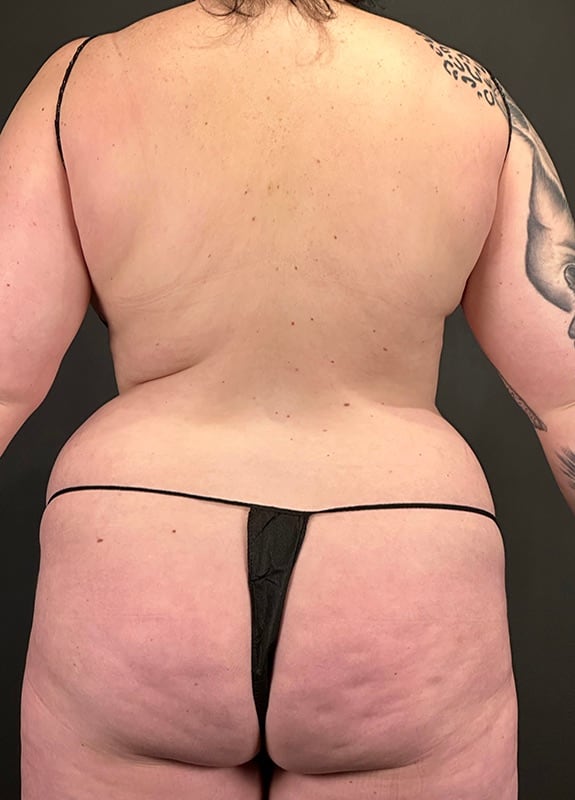 Tummy Tuck Before & After Image