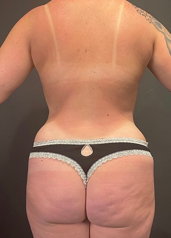 Tummy Tuck Before & After Image