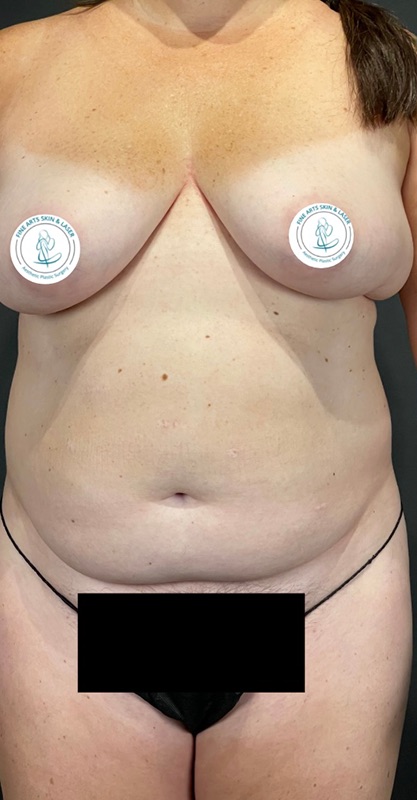 Tummy Tuck Before & After Image