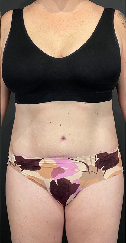 Tummy Tuck Before & After Image