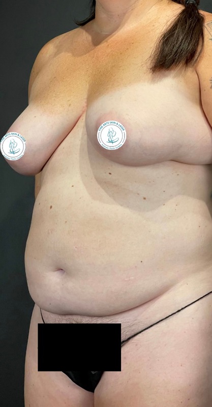 Tummy Tuck Before & After Image