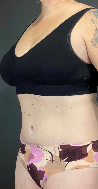 Tummy Tuck Before & After Image