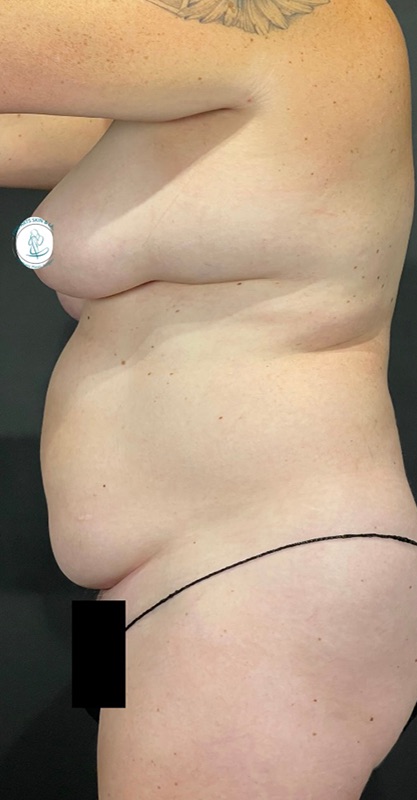 Tummy Tuck Before & After Image