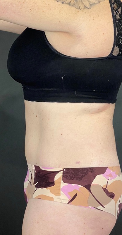 Tummy Tuck Before & After Image