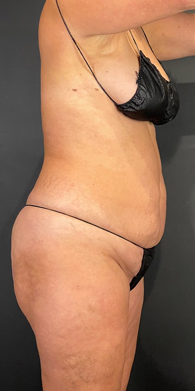 Tummy Tuck Before & After Image