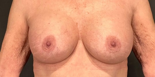 Breast Augmentation with Implants Before & After Image