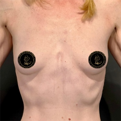 Breast Augmentation with Implants Before & After Image