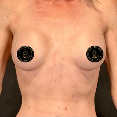 Breast Augmentation with Implants Before & After Image