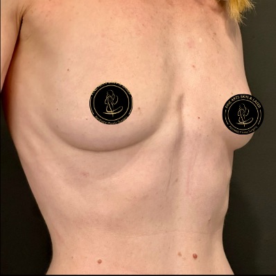 Breast Augmentation with Implants Before & After Image