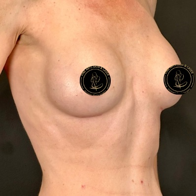 Breast Augmentation with Implants Before & After Image