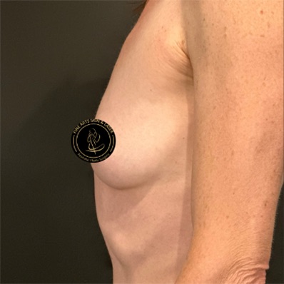 Breast Augmentation with Implants Before & After Image