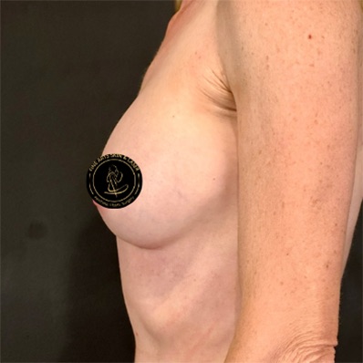 Breast Augmentation with Implants Before & After Image