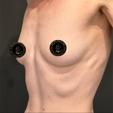 Breast Augmentation with Implants Before & After Image
