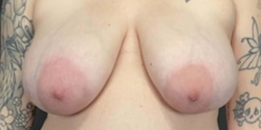 Breast Lift Before & After Image