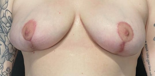 Breast Lift Before & After Image