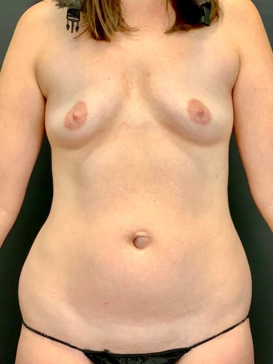 Fat Transfer Breast Augmentation Before & After Image