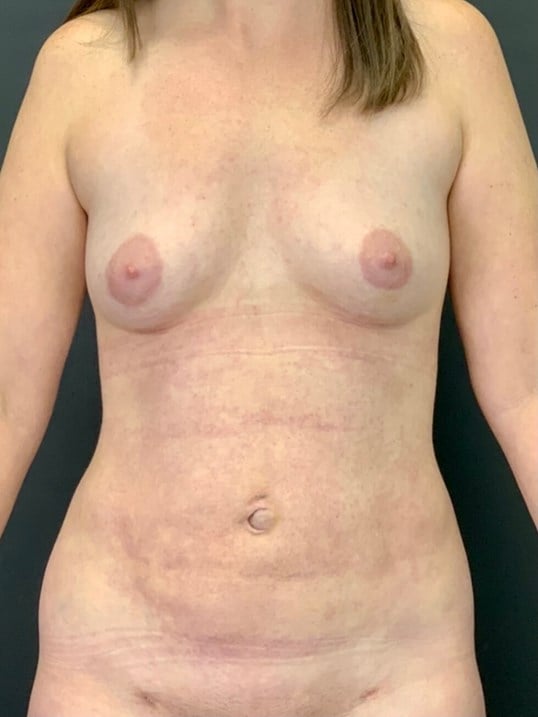 Fat Transfer Breast Augmentation Before & After Image