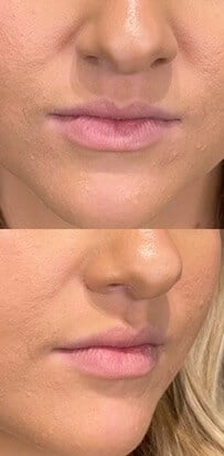 Dermal Fillers Before & After Image
