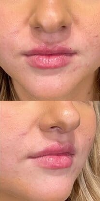 Dermal Fillers Before & After Image