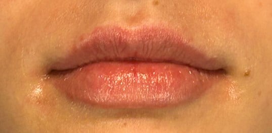 Dermal Fillers Before & After Image