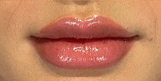 Dermal Fillers Before & After Image