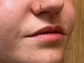 Dermal Fillers Before & After Image